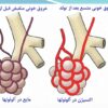 روش های حمایت تنفسی در نوزادان نارس