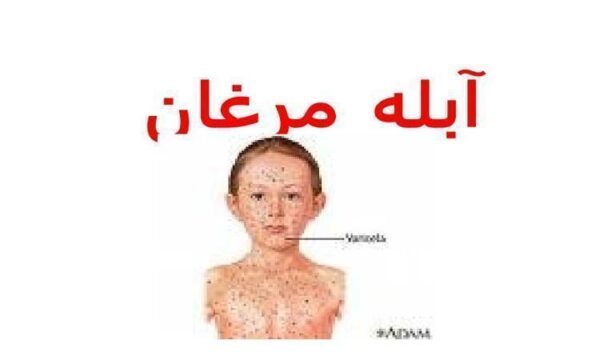 آبله-مرغان